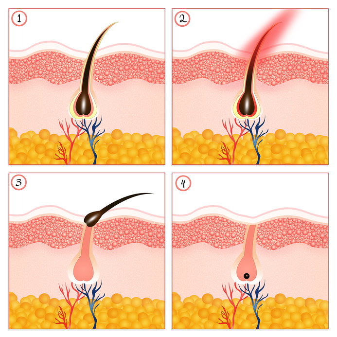 Permanent hair removal